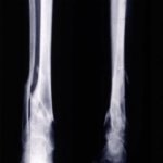 ecm-fisioterapia-corso-fad-16-guarigione-delle-fratture