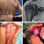 LIVE SURGERY - per il successo riabilitativo nella spalla post-chirurgica