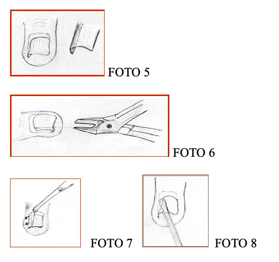 unghia incarnita fig5-6-7-8