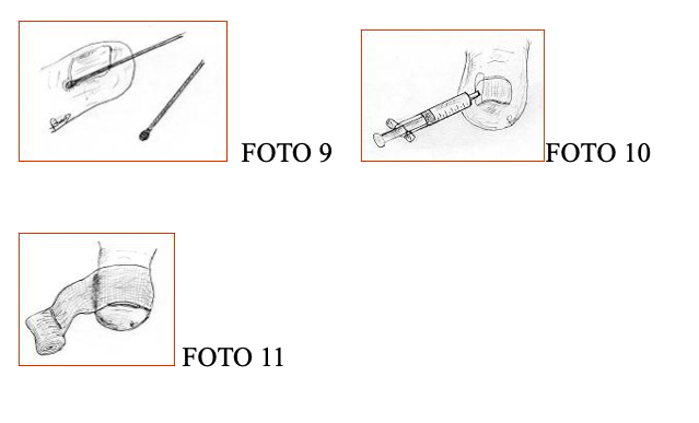 unghia incarnita fig 9 10 11