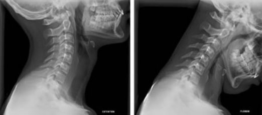 artrosi cervicale come si diagnostica