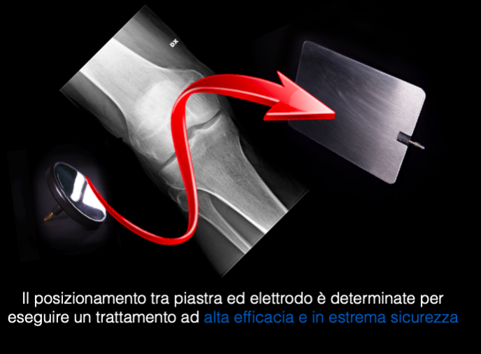 tecarterapia geometria fra piastra ed elettrodi