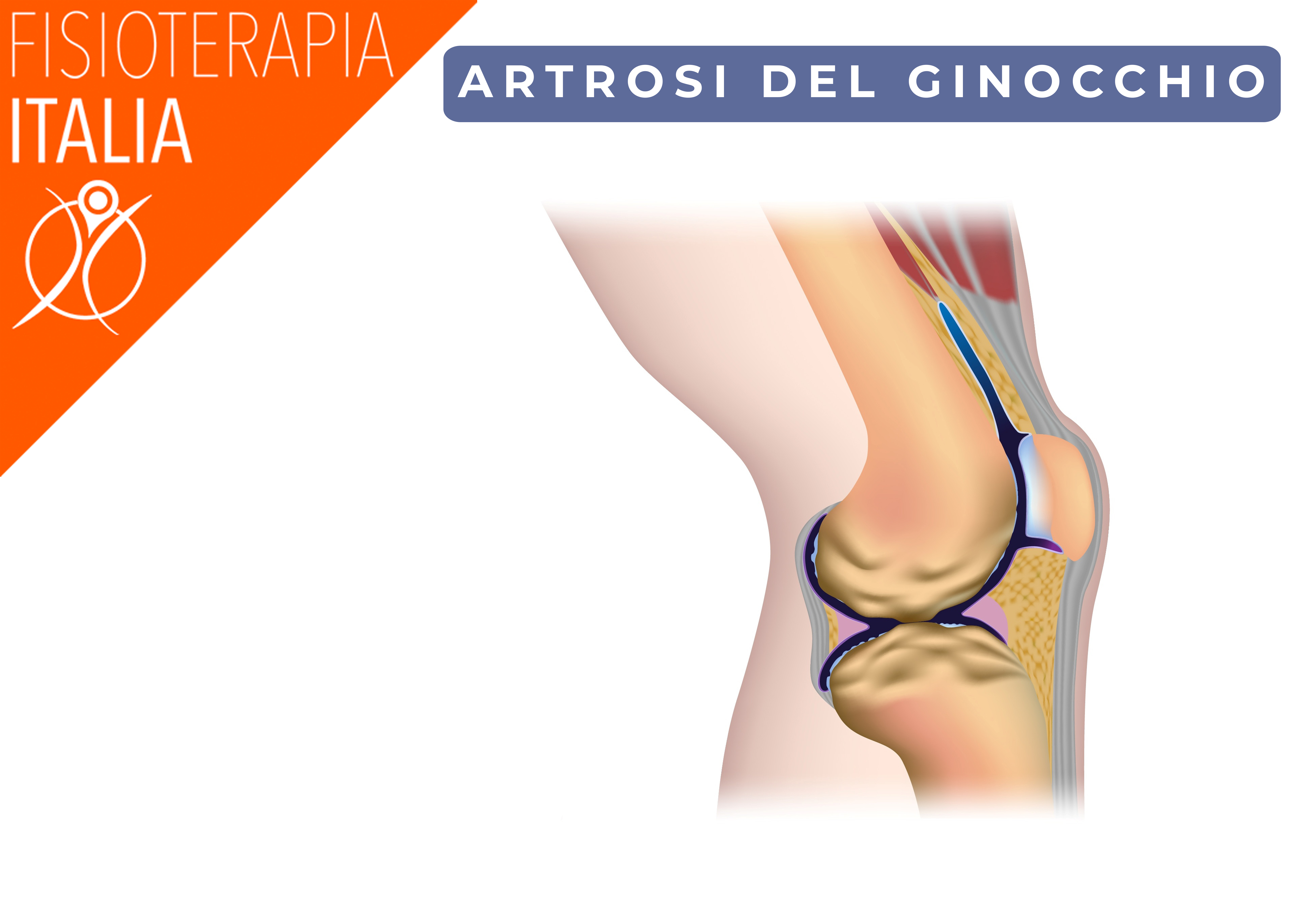 cause ginocchio scricchiola artrosi