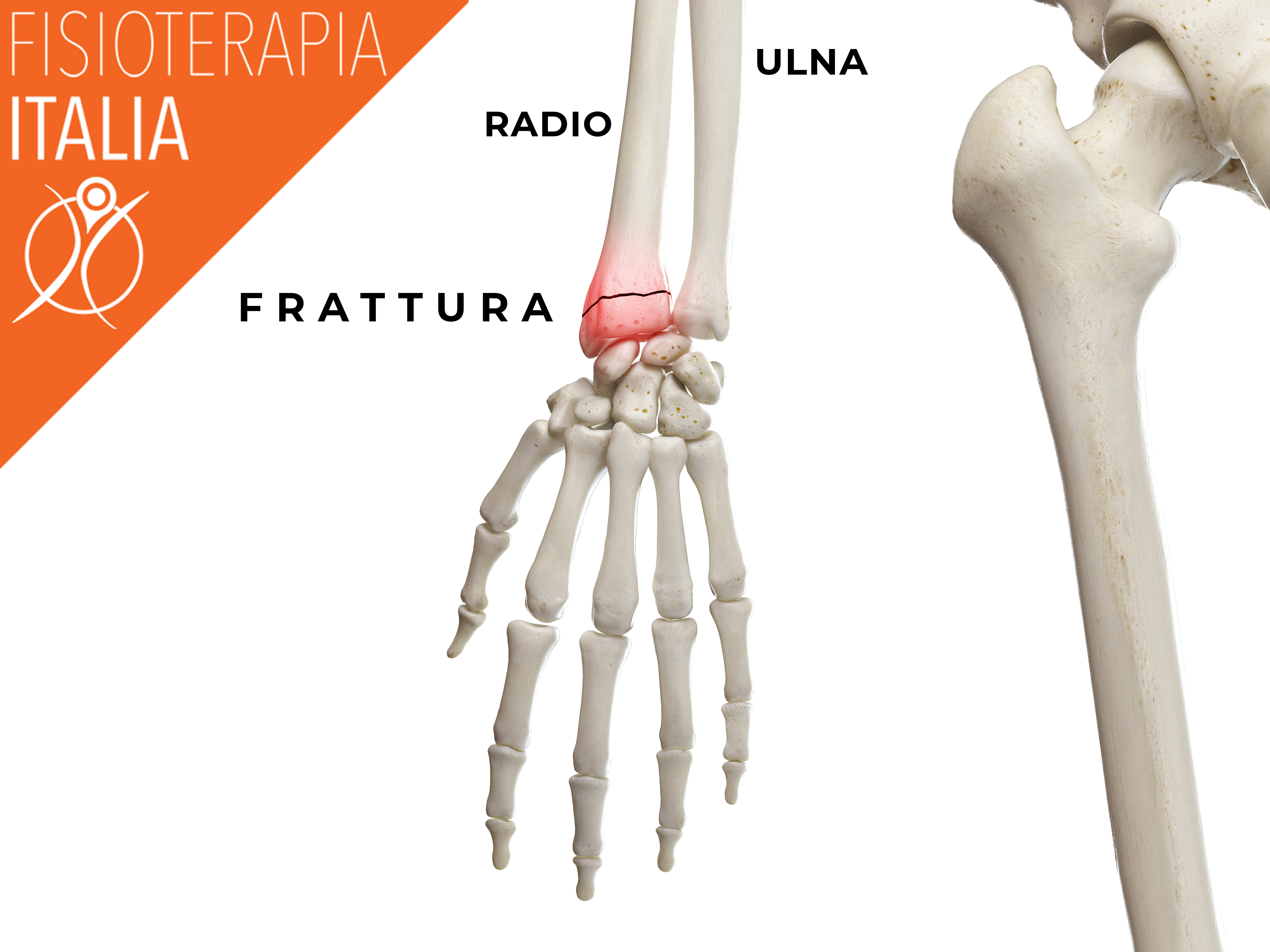 diverse fratture del polso