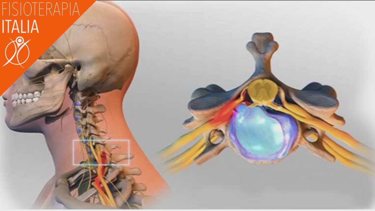 dolore al braccio ernia del disco