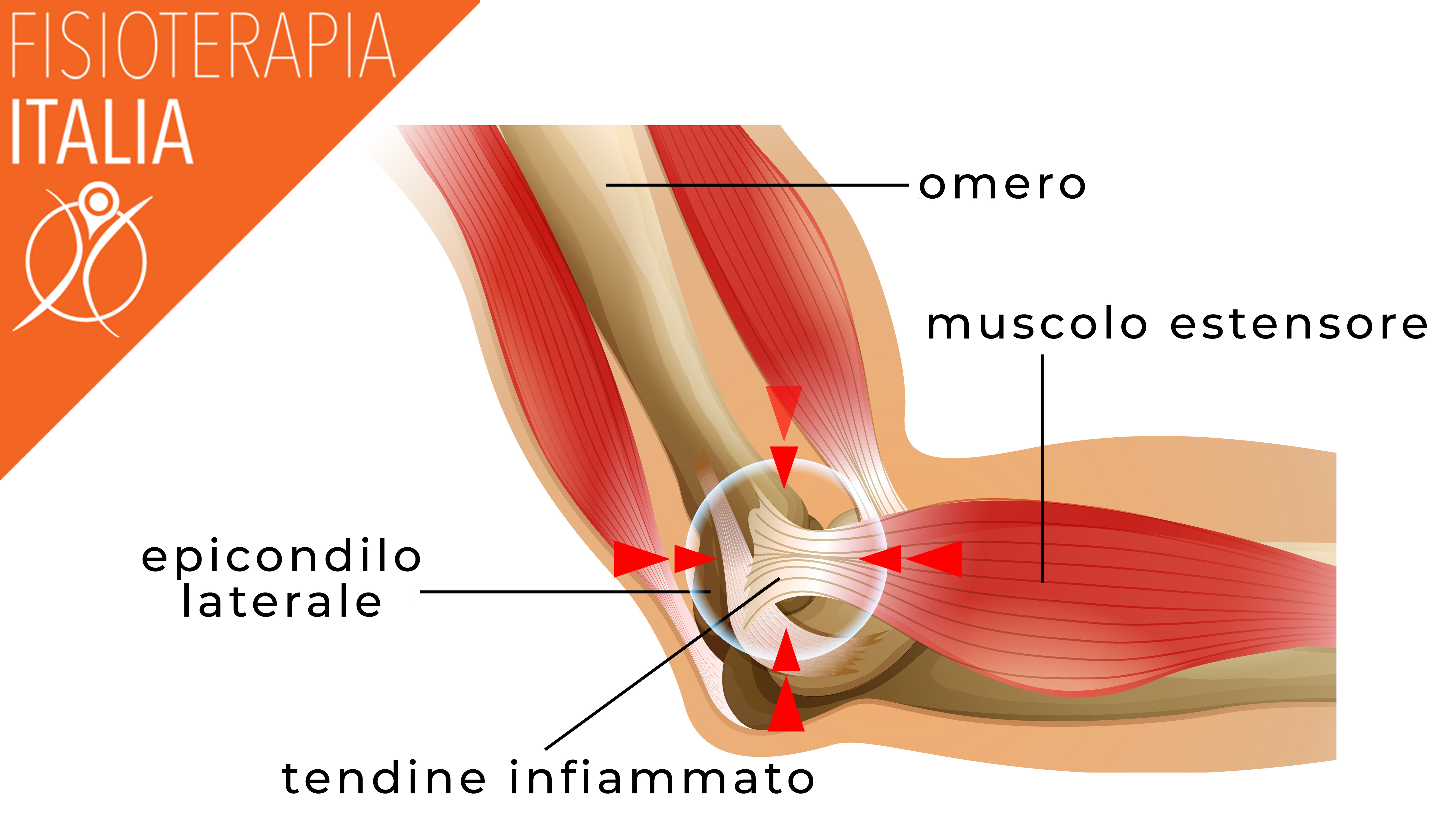 epicondilite come insorge