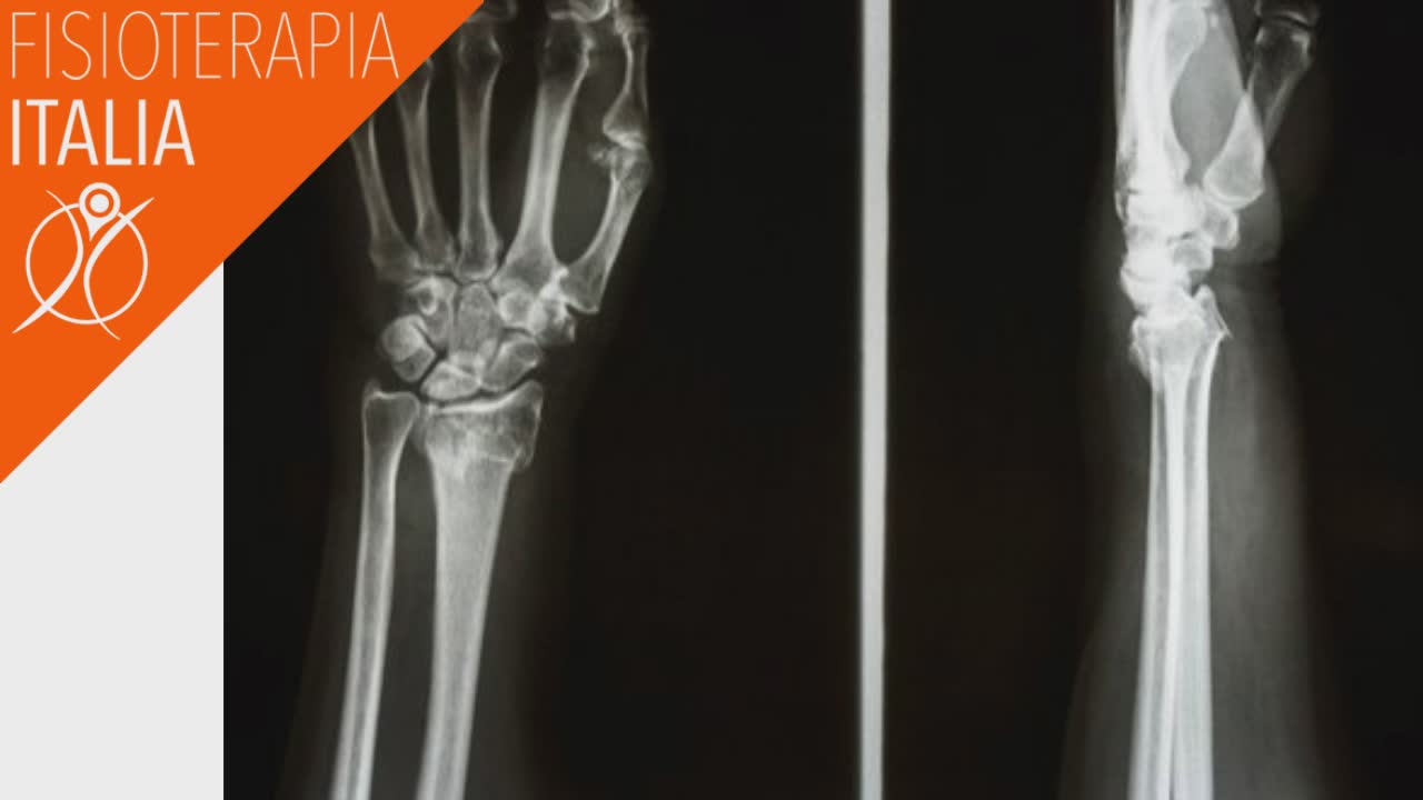 frattura di colles sintomi e diagnosi