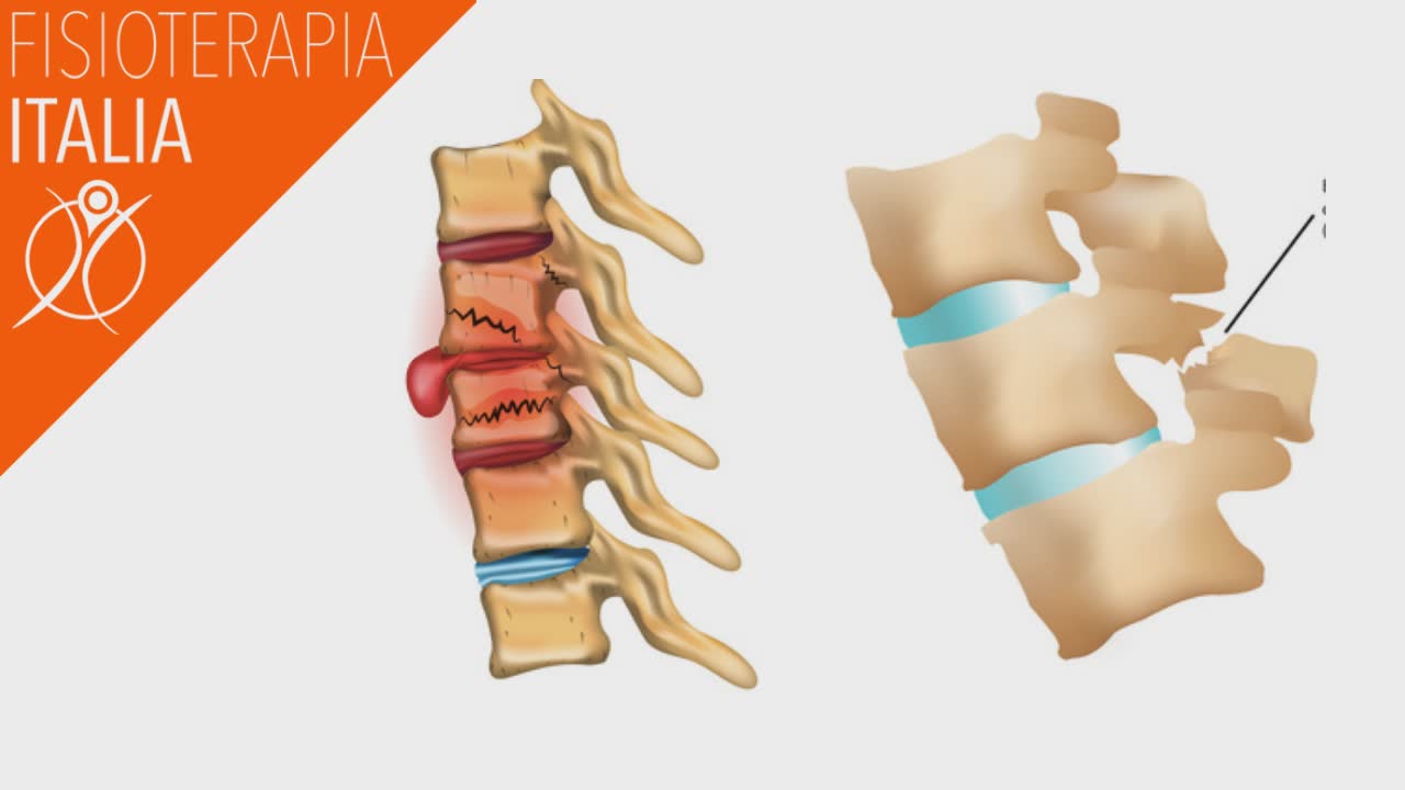 fratture cervicali meliche