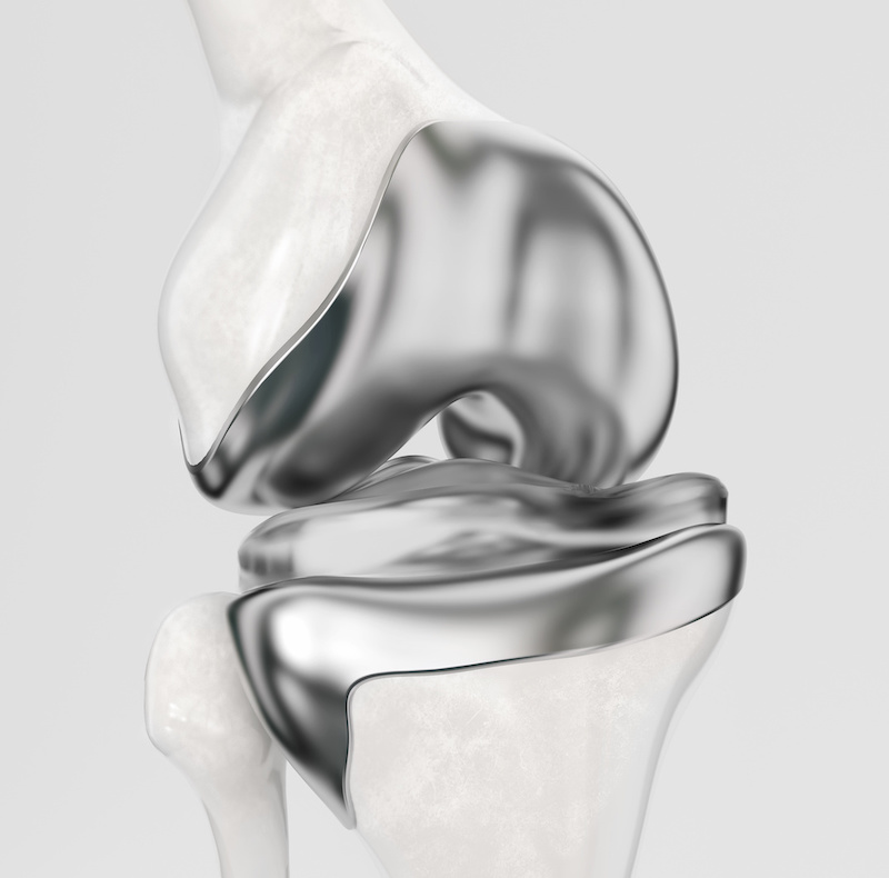 ginocchio chirurgia e protesi