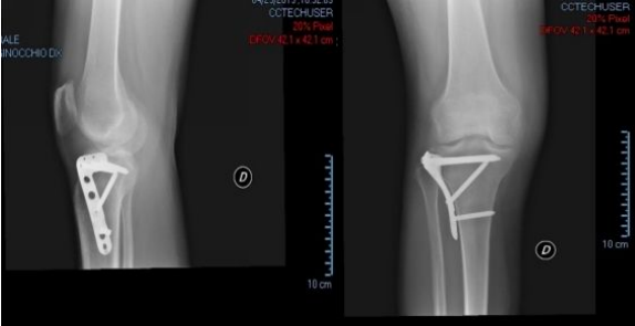ginocchio e osteosintesi