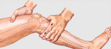 ginocchio ricostruzione loca