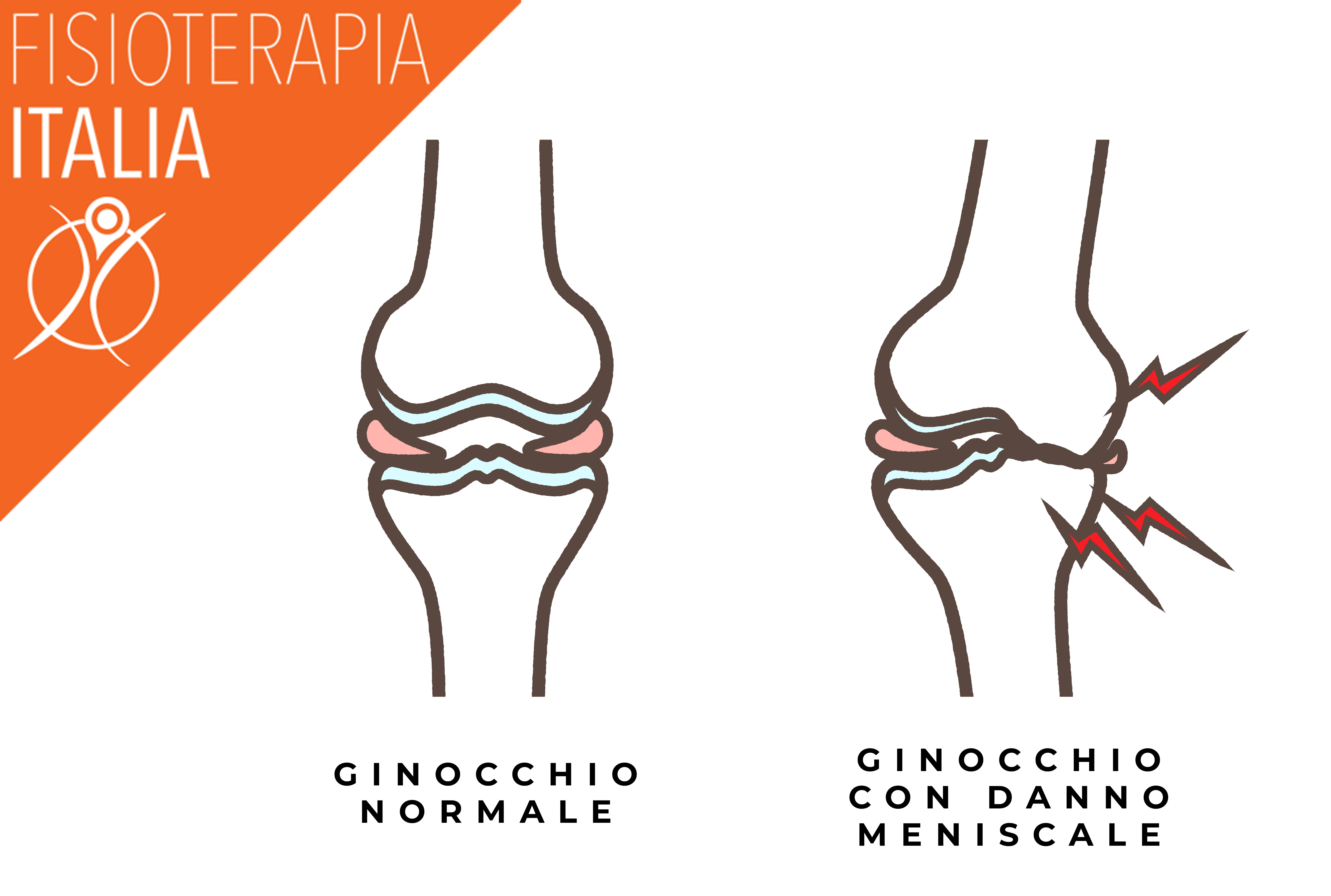 ginocchio valgo e danno meniscale