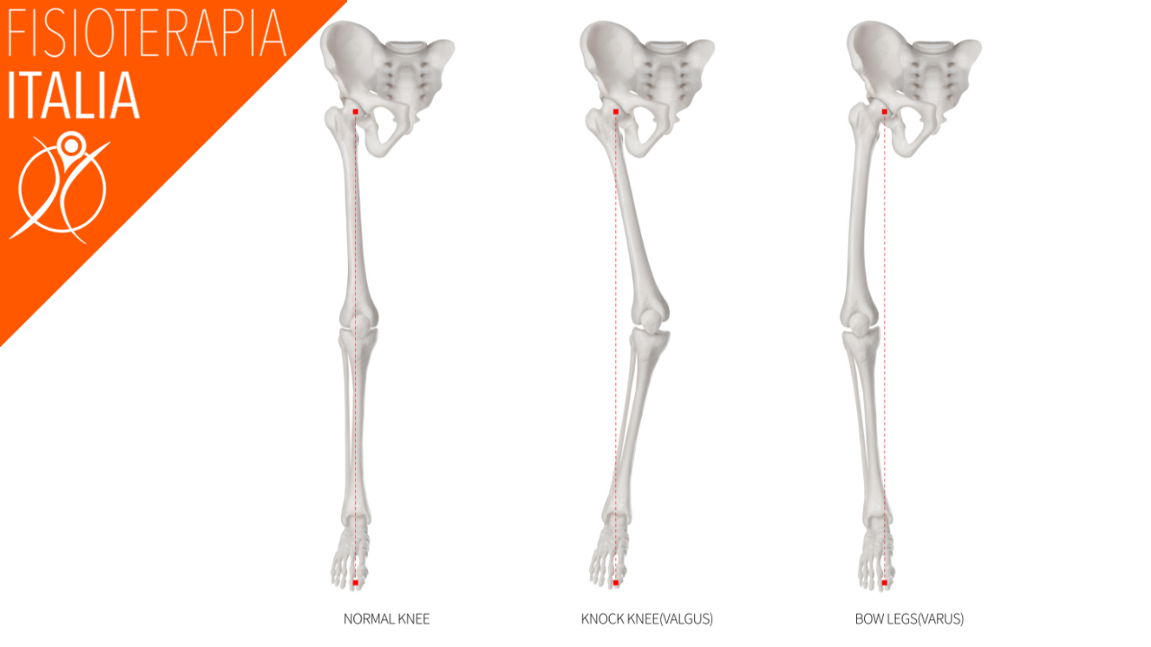 ginocchio varo riconoscerlo