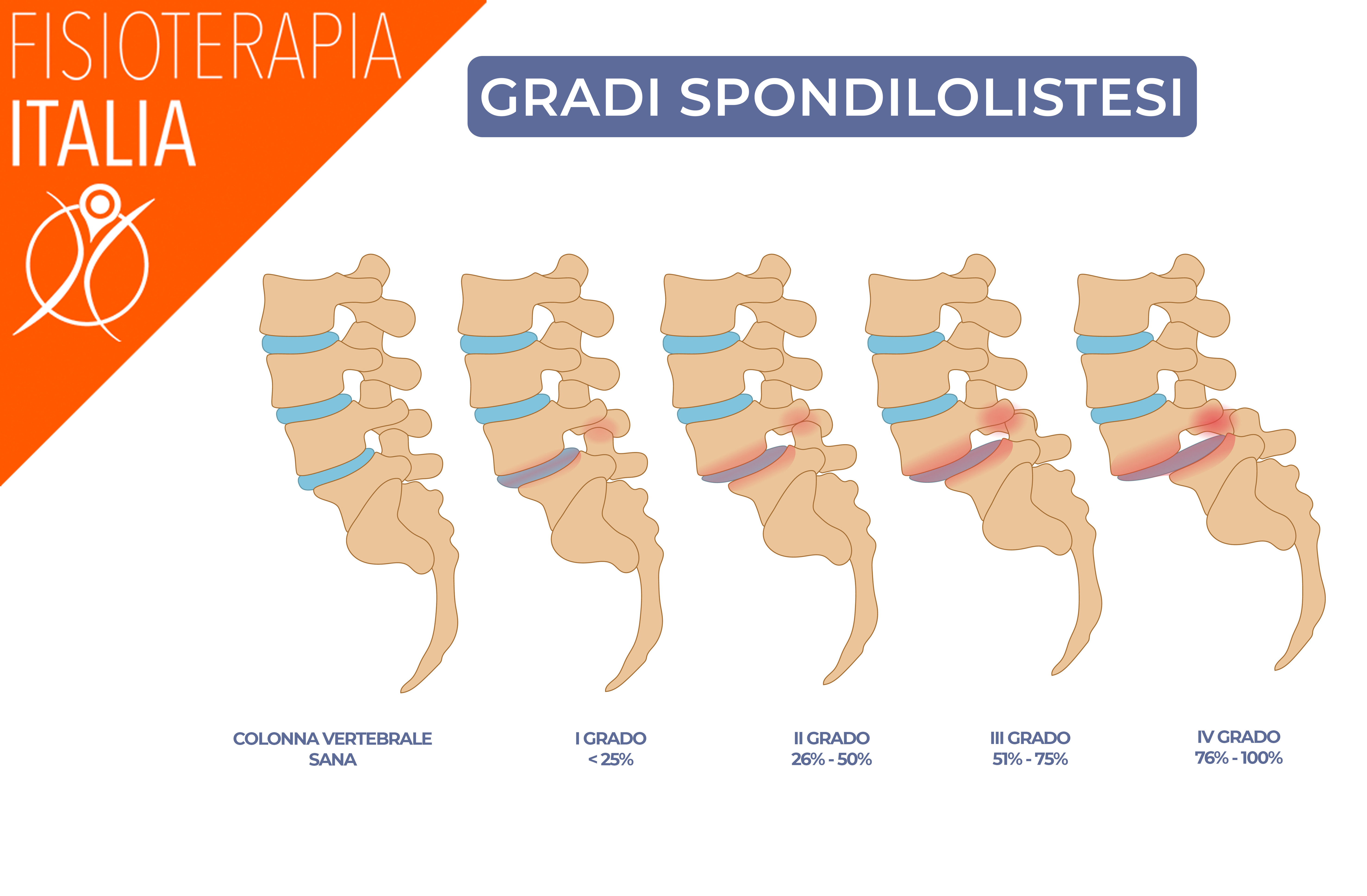 La spondilolistgesi e gradi