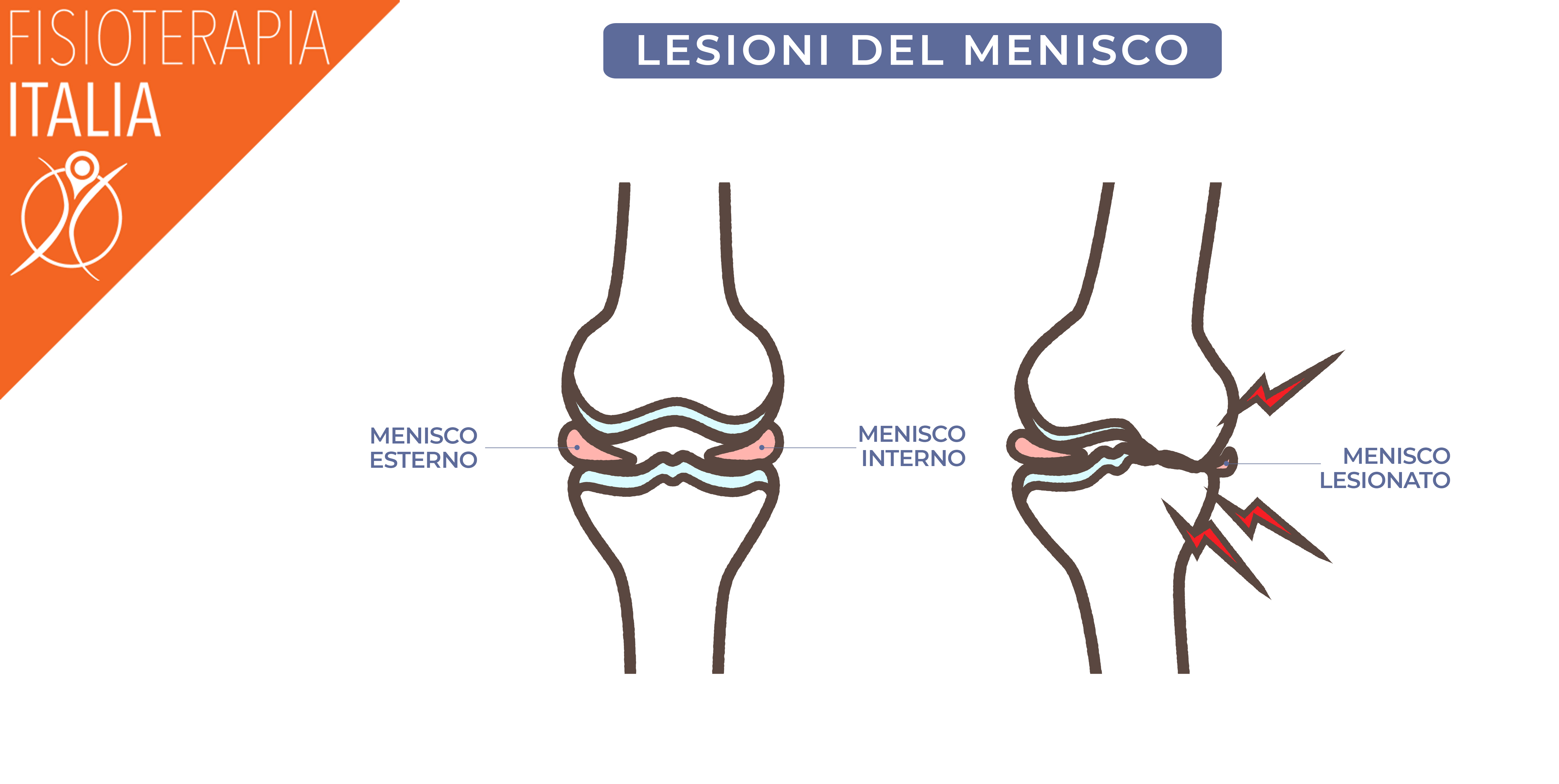 lesioni del menisco