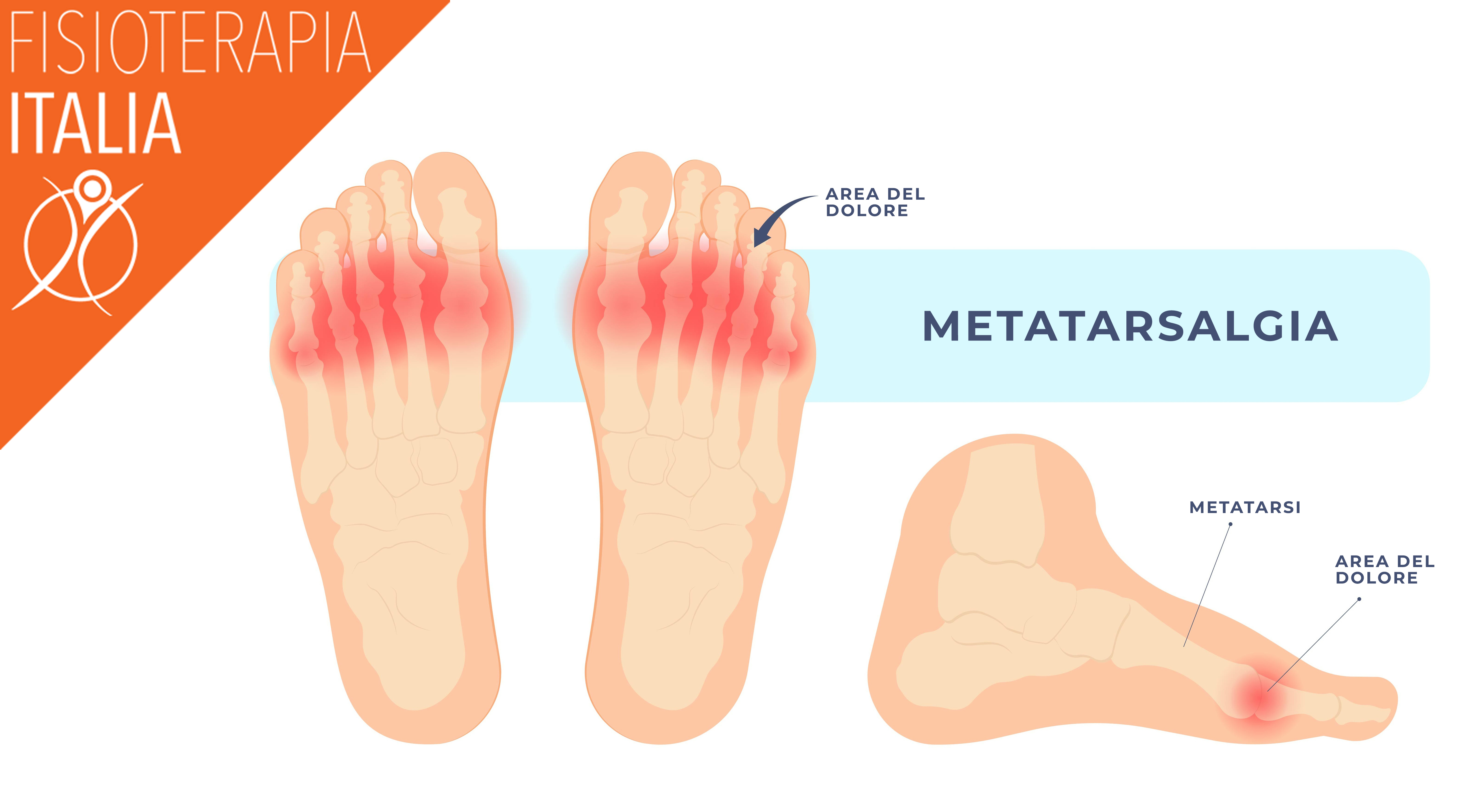 metatarsalgia