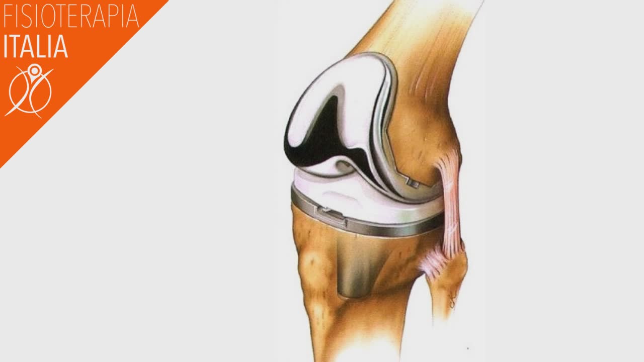 protesi ginocchio