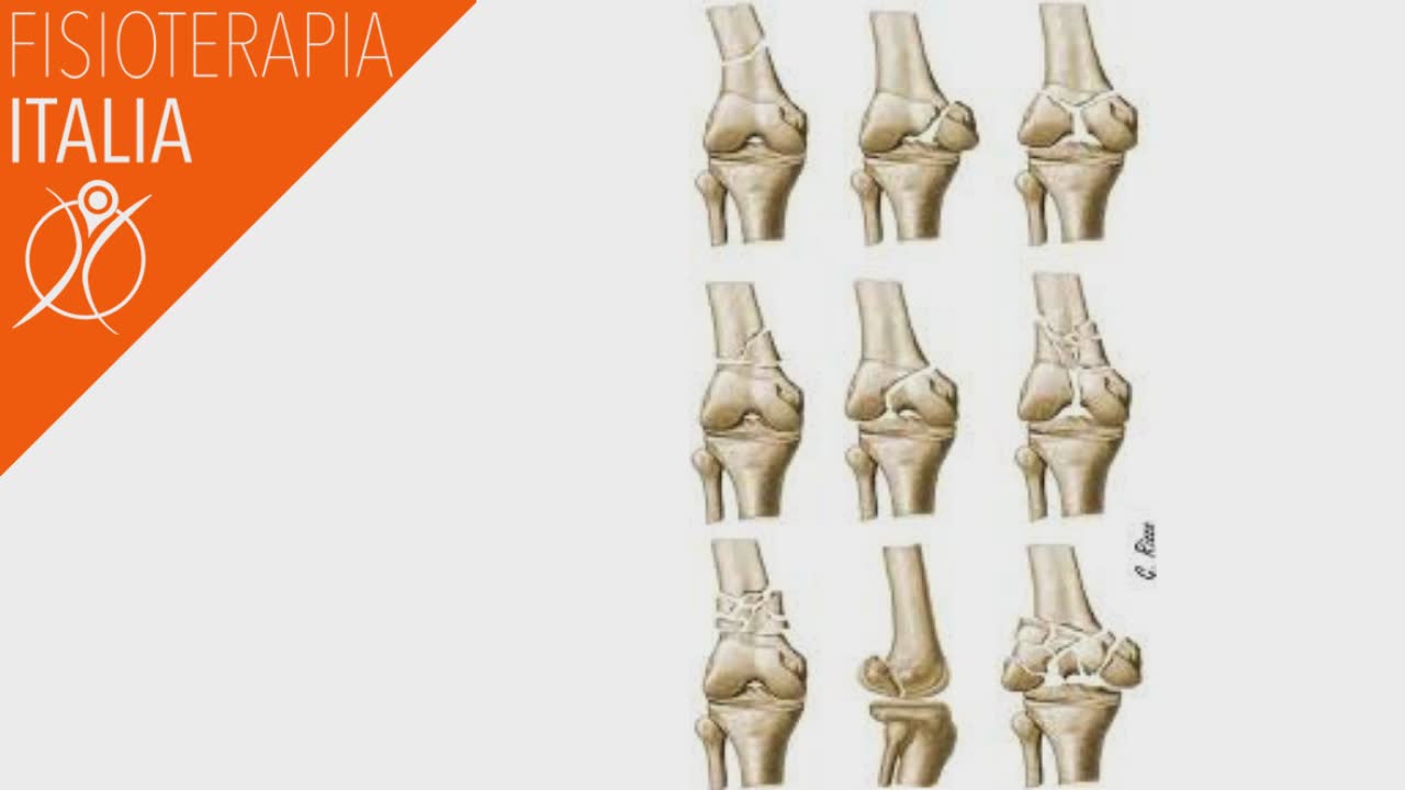 Calcolo Risarcimento Frattura Piatto Tibiale Frattura Del Piatto Tibiale Tempi Di Recupero - onemedica