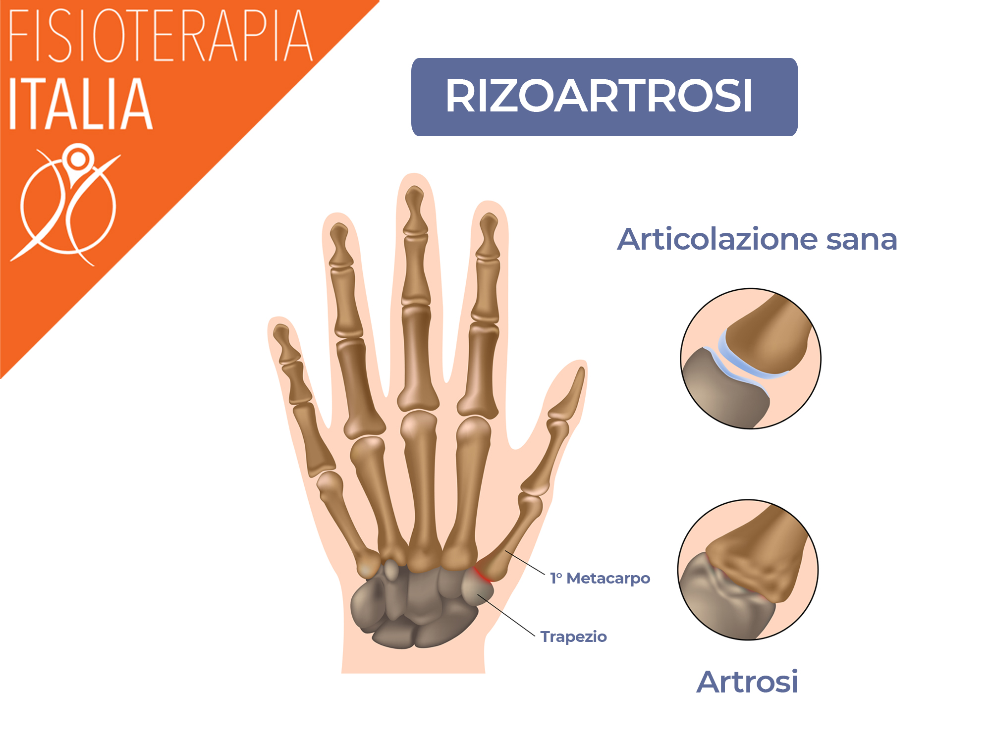 rizoartrosi del pollice