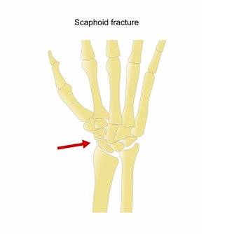 tratamentul artrozei scafoide scafoide)