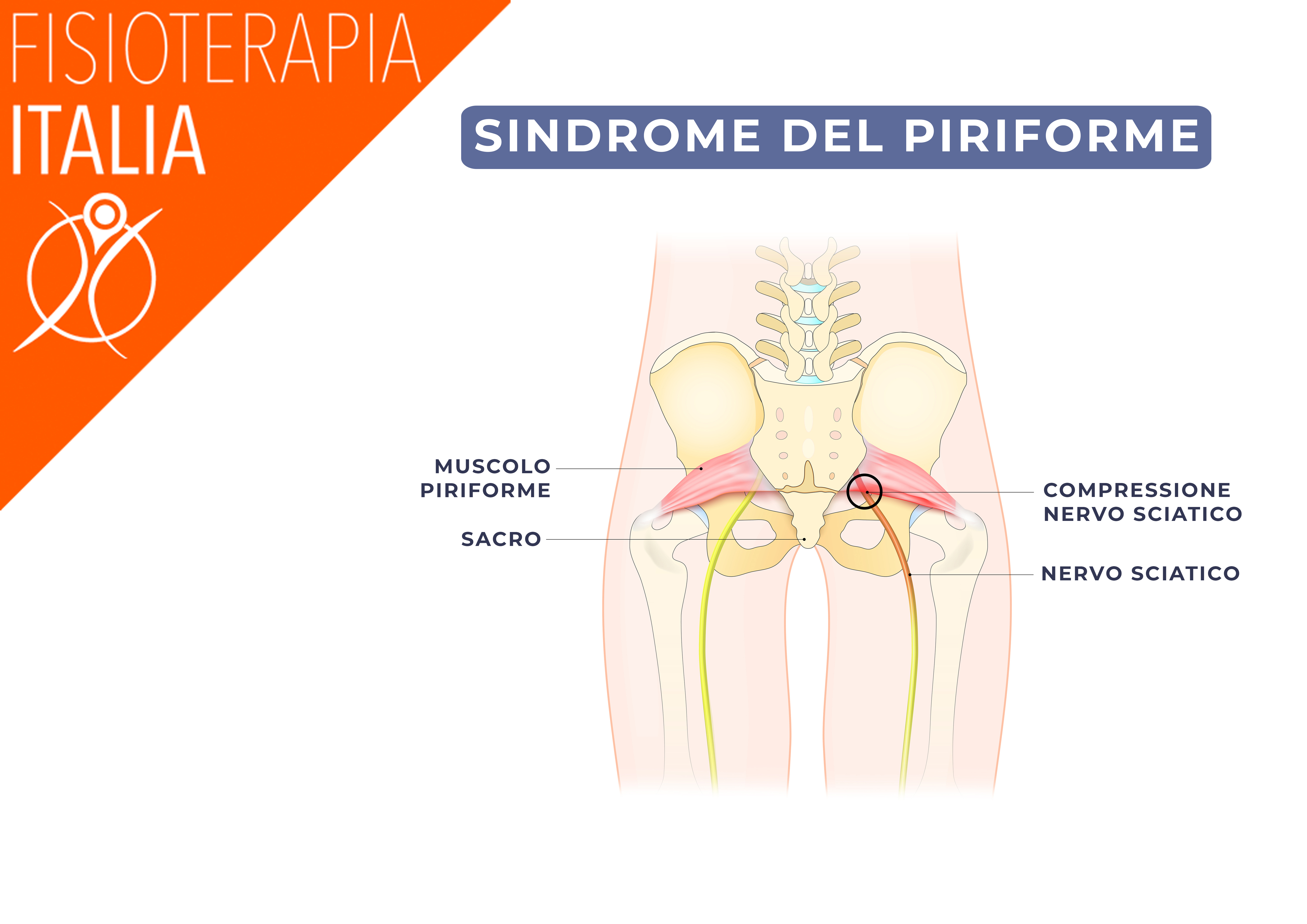 sindrome del piriforme segni e sintomi