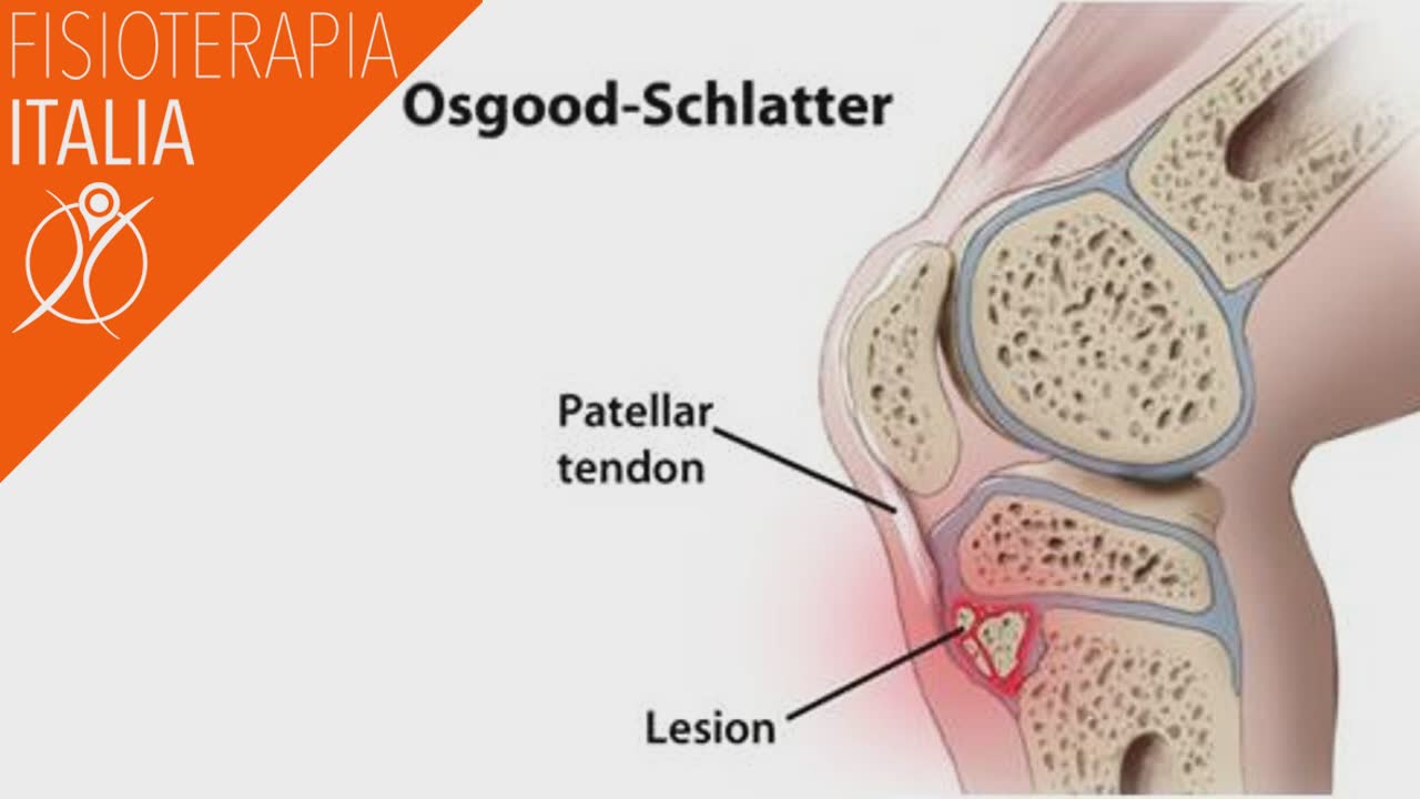 Il morbo di osgood schlatter cause e rimedi sindrome di osgood schlatter cosa significa
