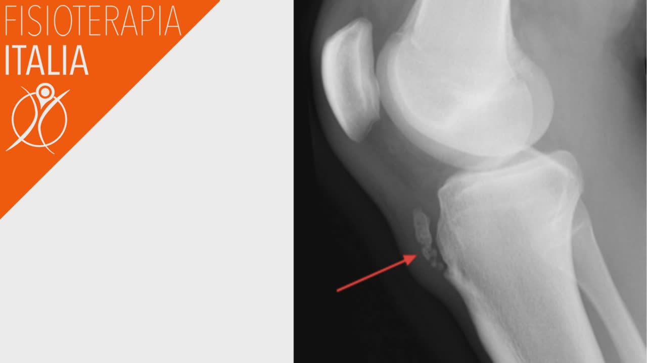 Il morbo di osgood schlatter cause e rimedi sindrome di osgood schlatter diagnosi
