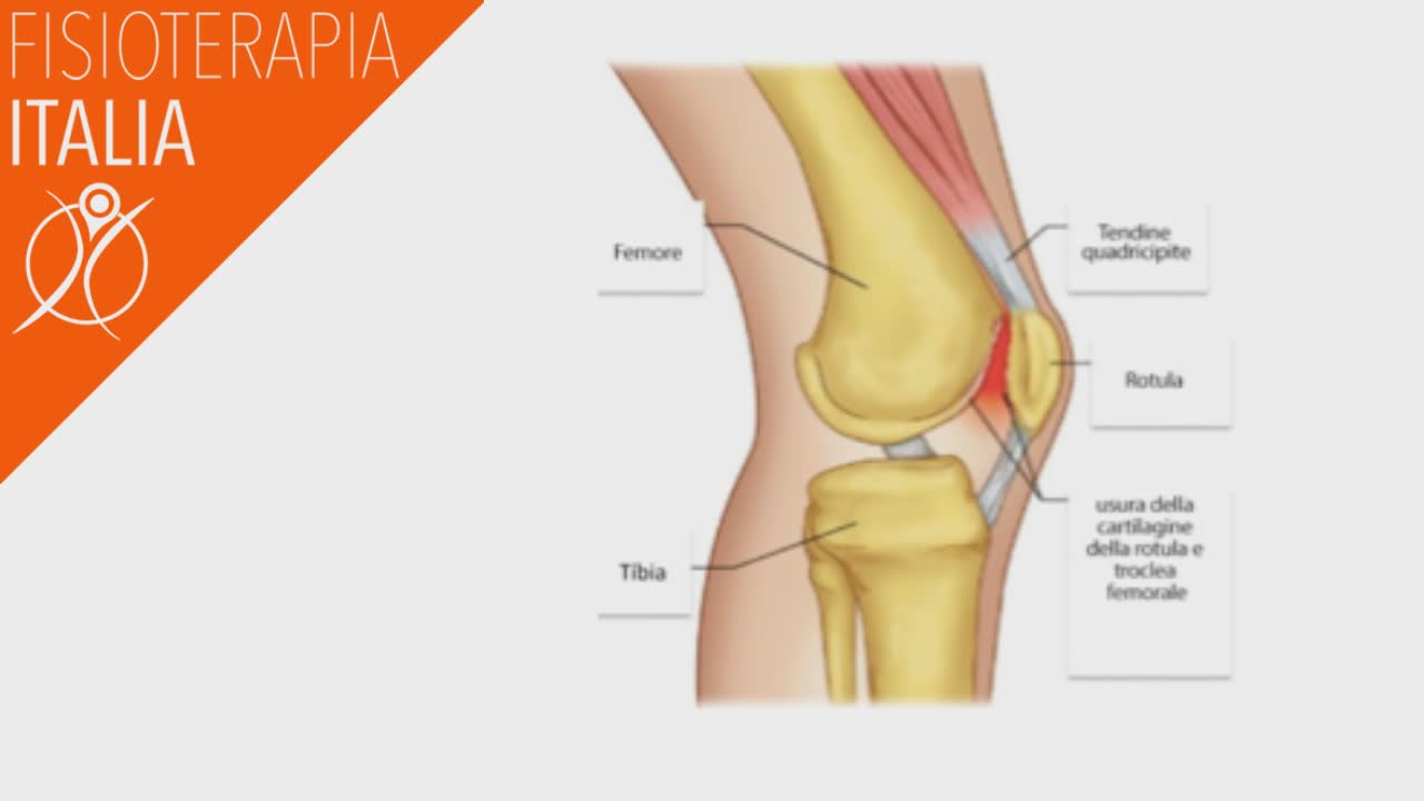 sindrome femoro rotulea cause