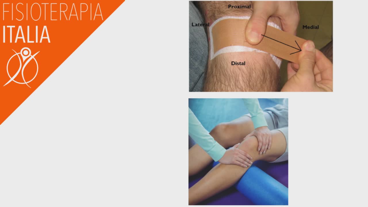 sindrome femoro rotulea fisioterapia efficace