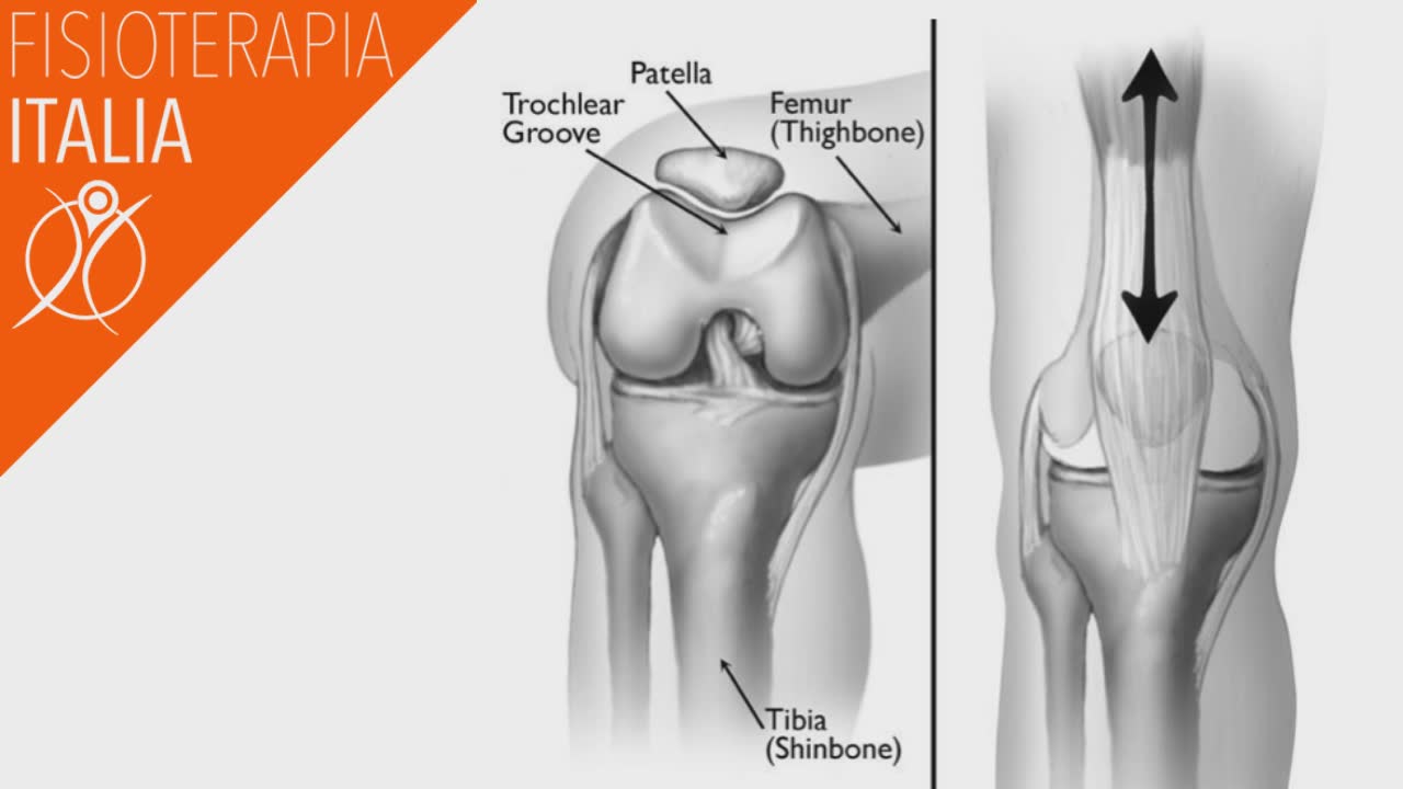 sindrome femoro rotulea incidenza