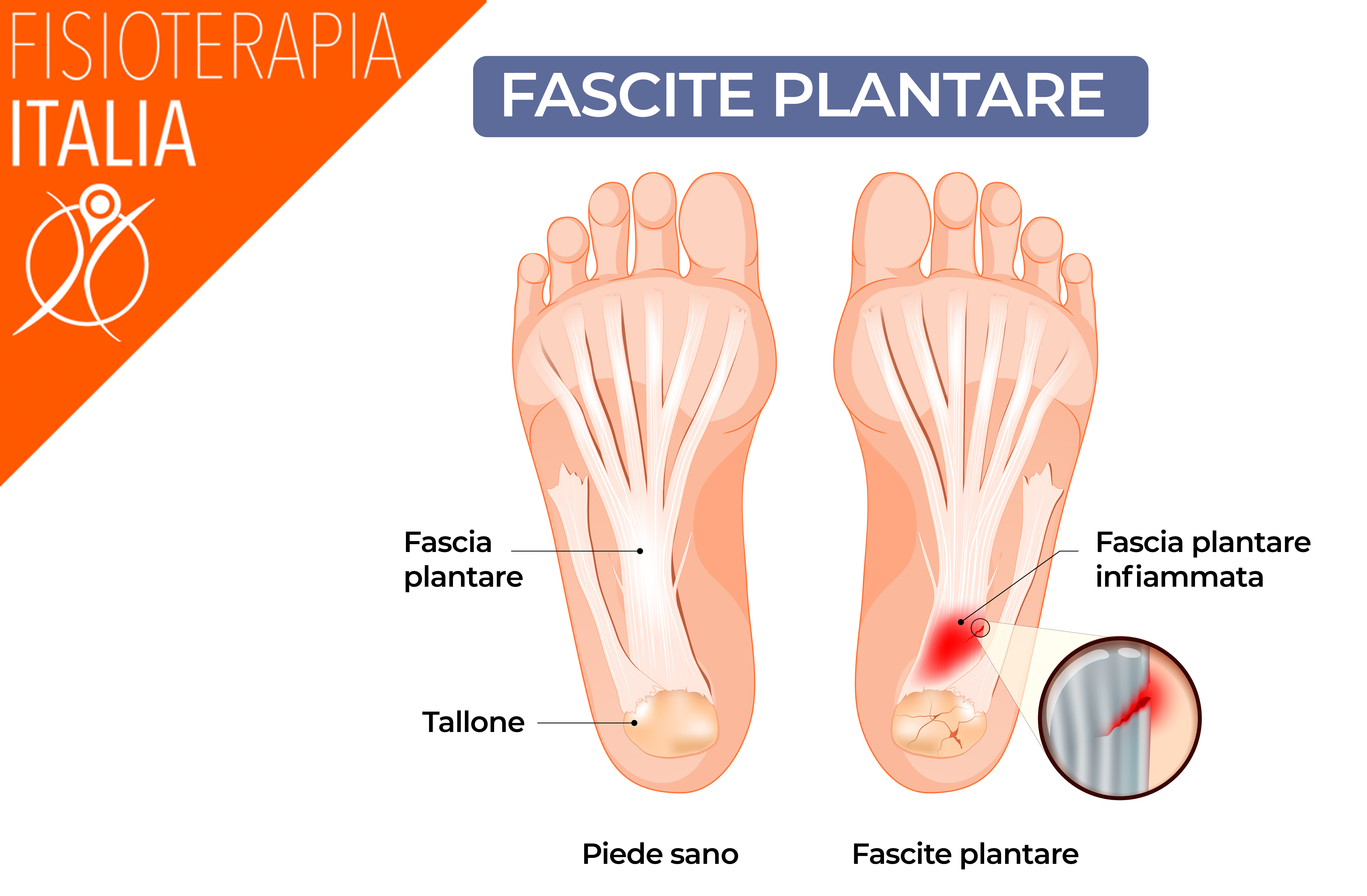 MASSAGGIO DEI PIEDI come rimedio per piedi dolorosi, deambulazione  faticosa, metatarsalgie, talloniti, tendiniti e fasciti plantari