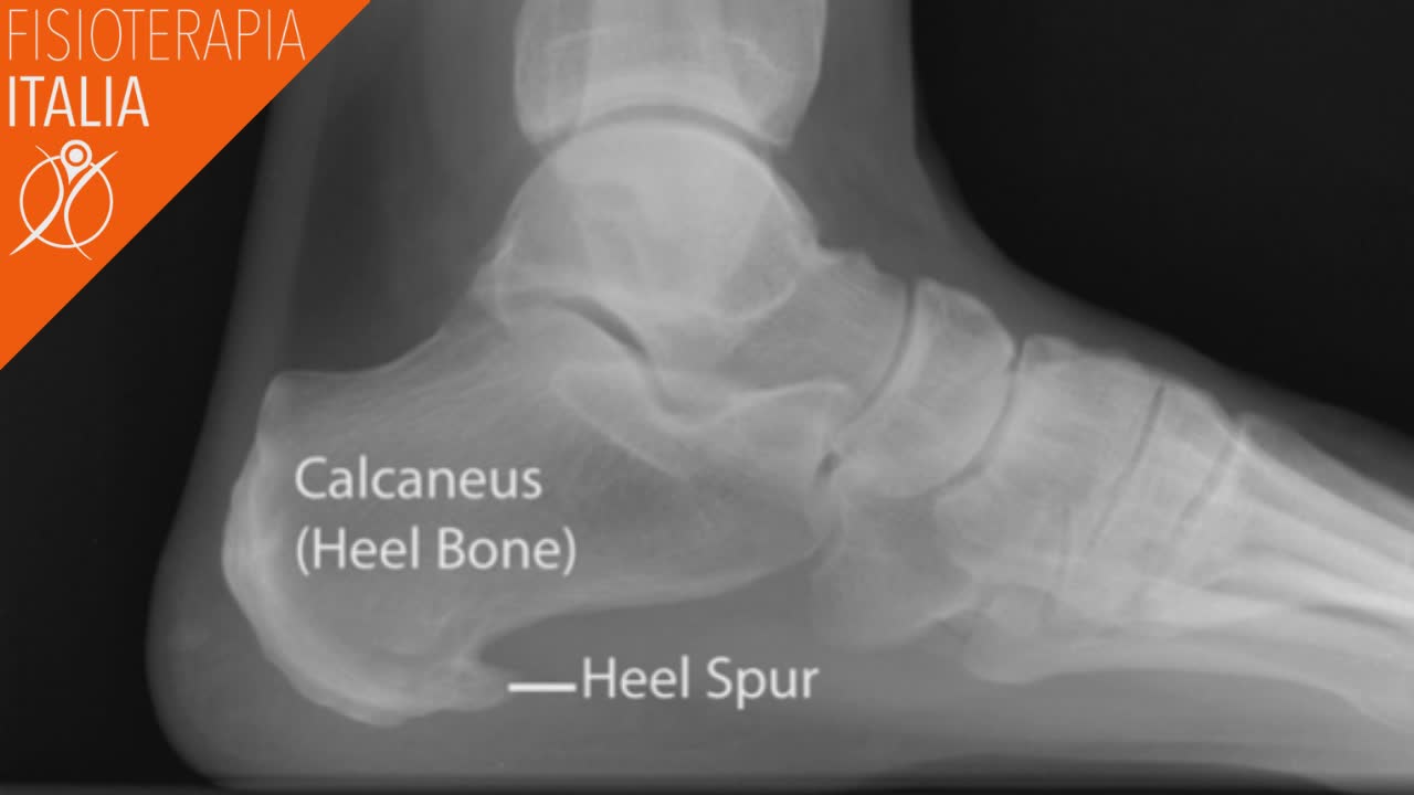 sperone calcinare sintomi e cure