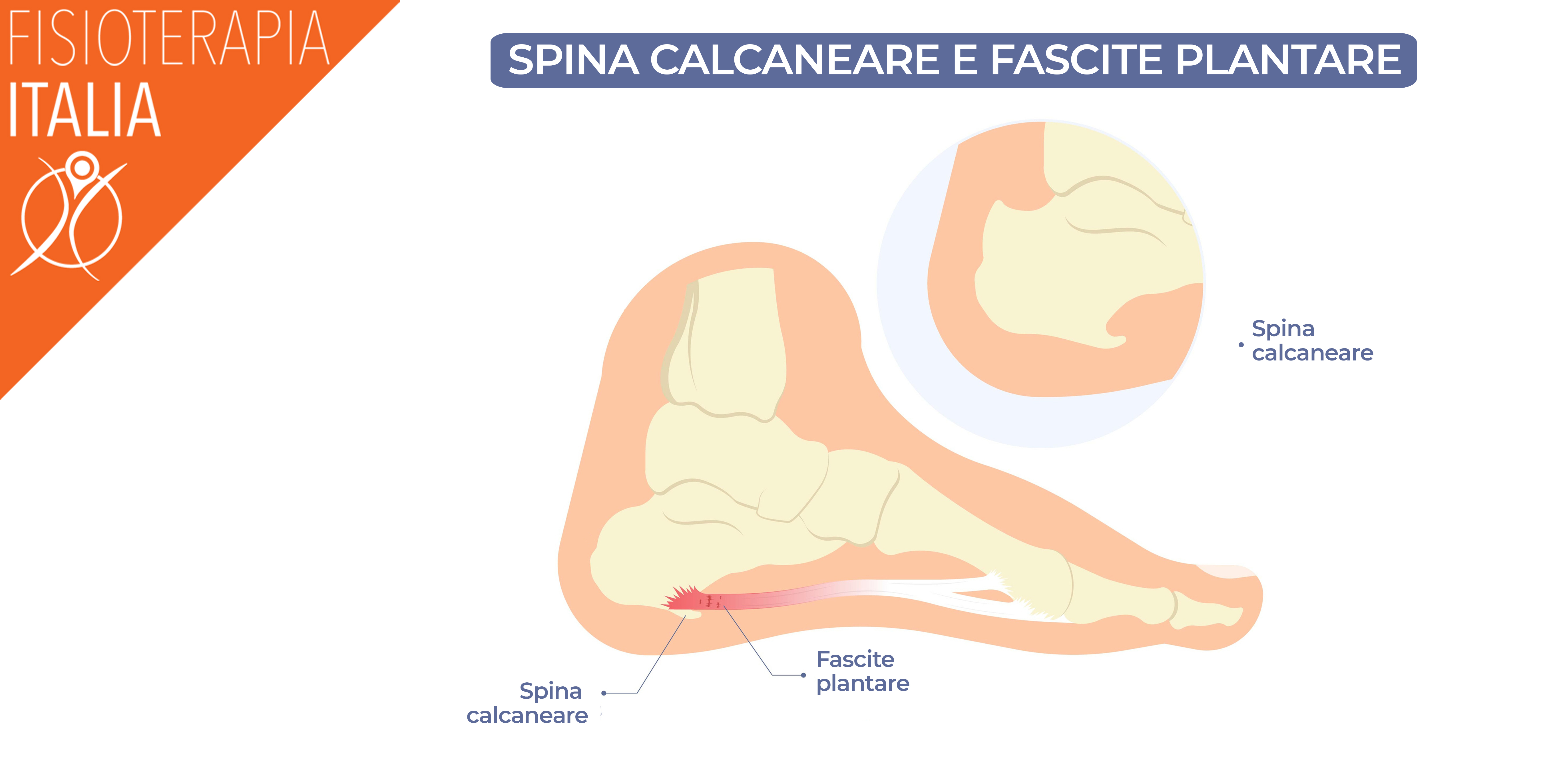 spina calcaneare fascite plantare