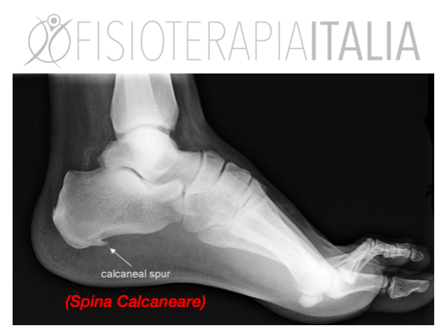 spina calcinare tecnologia e terapia fisica