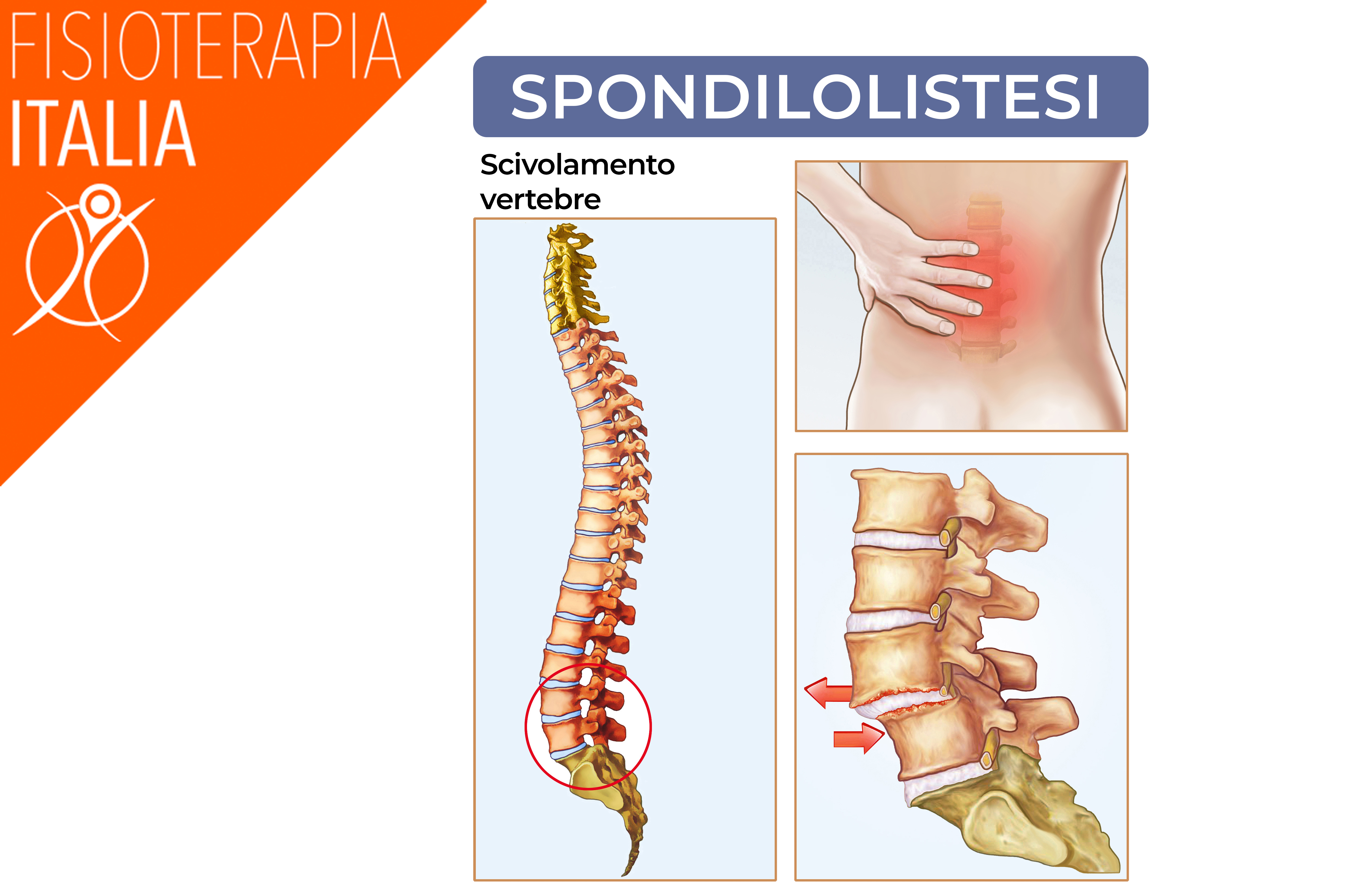 spondilolistesi anterolistesi retrolistesi