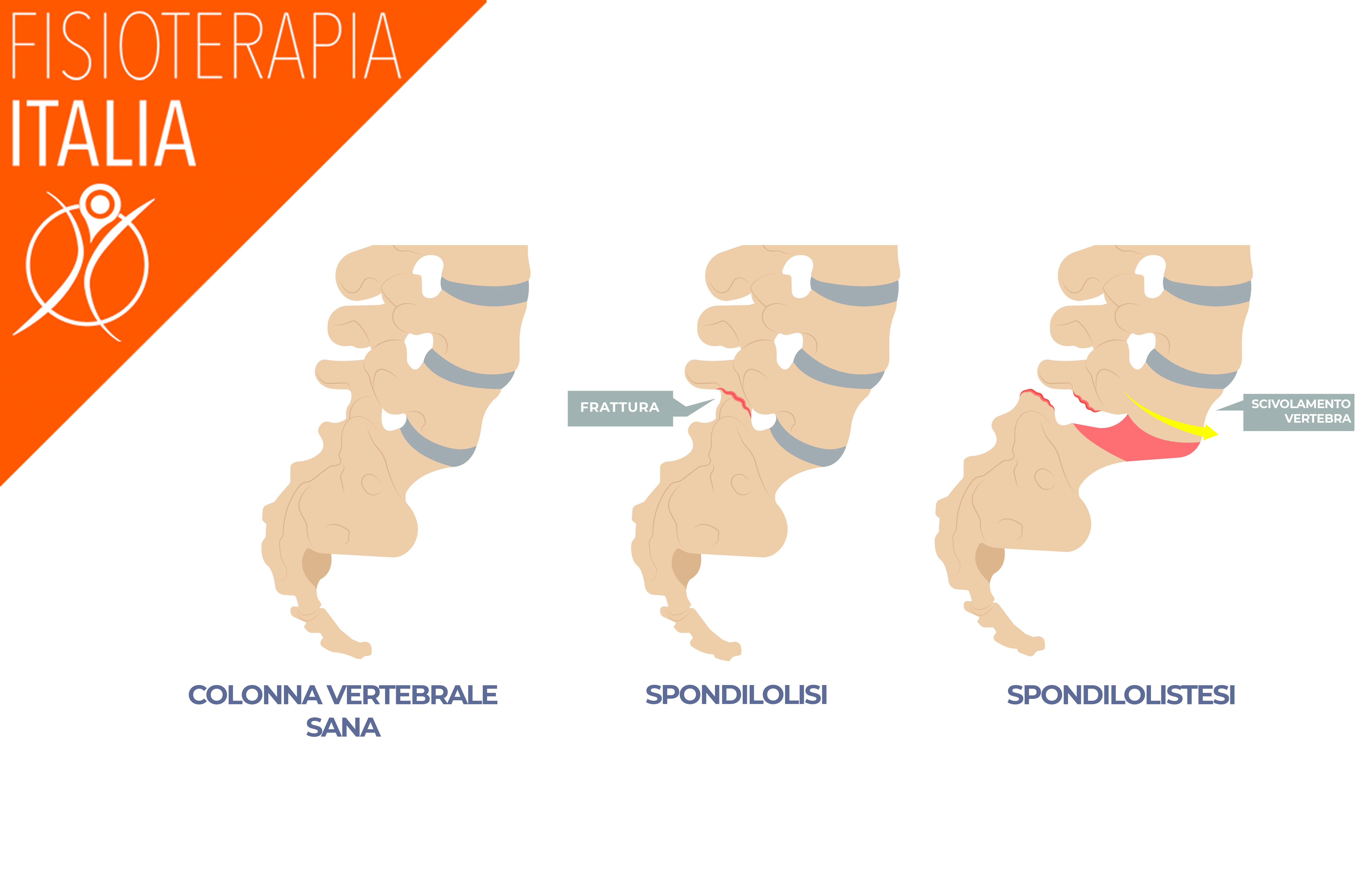 spondilolistesi e spondilolisi differenze