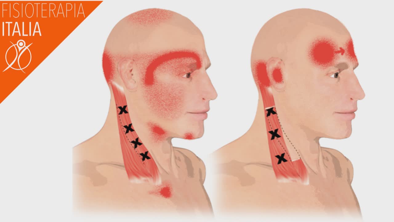 sternocleidomastoideo esercizi propriocettivi