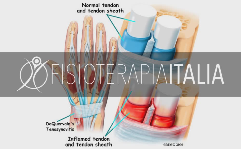 Tendinite Al Polso Come Curarla E Riconoscerla