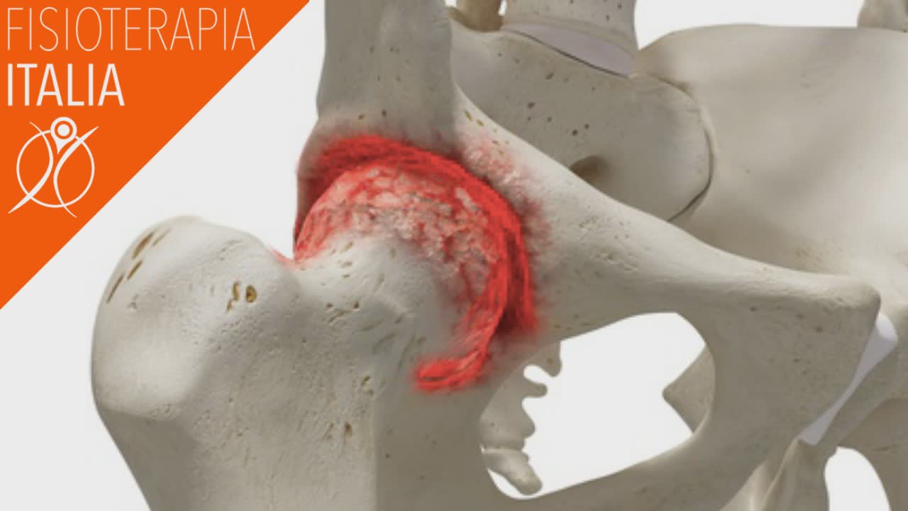 artrosi dell'anca dolore e rigidità