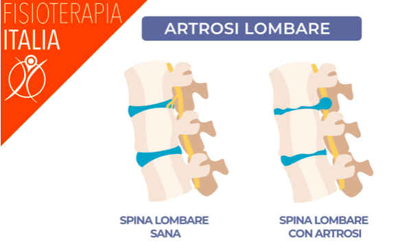 artrosi lombare cosa significa