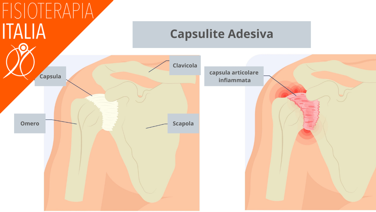 capsulite adesiva cause