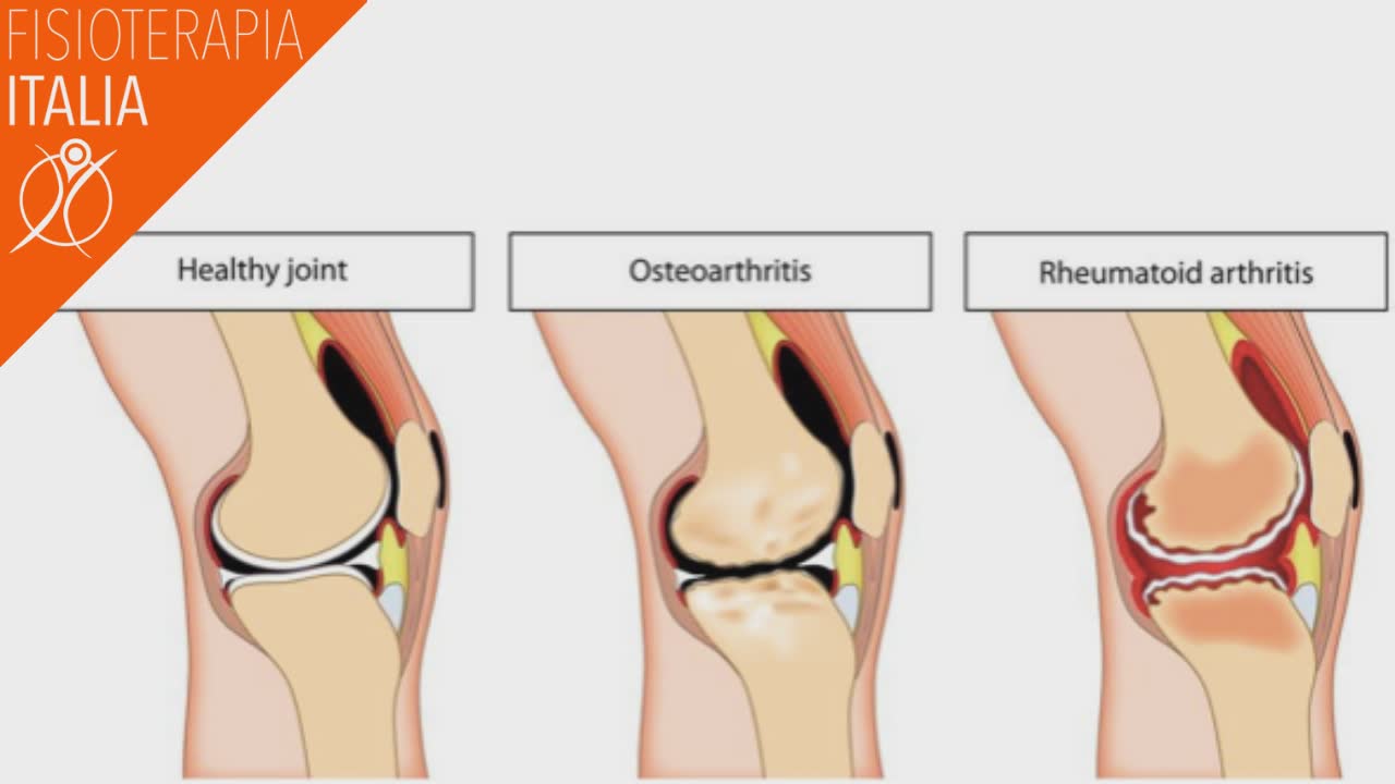 cartilagine e artrosi