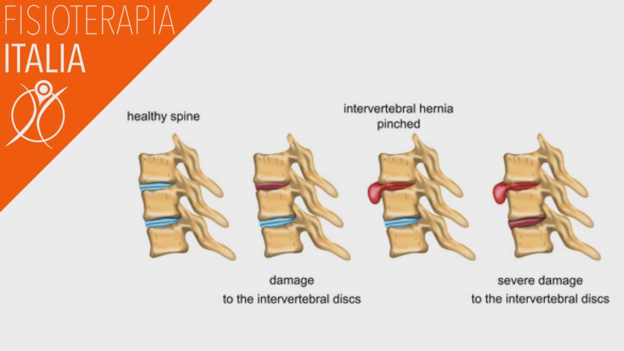 cervicale ernia e discopatia