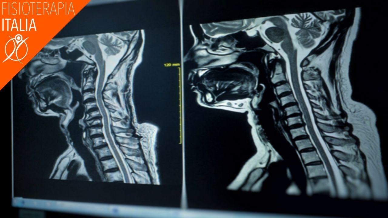 cervicale stabilizzare i sintomi