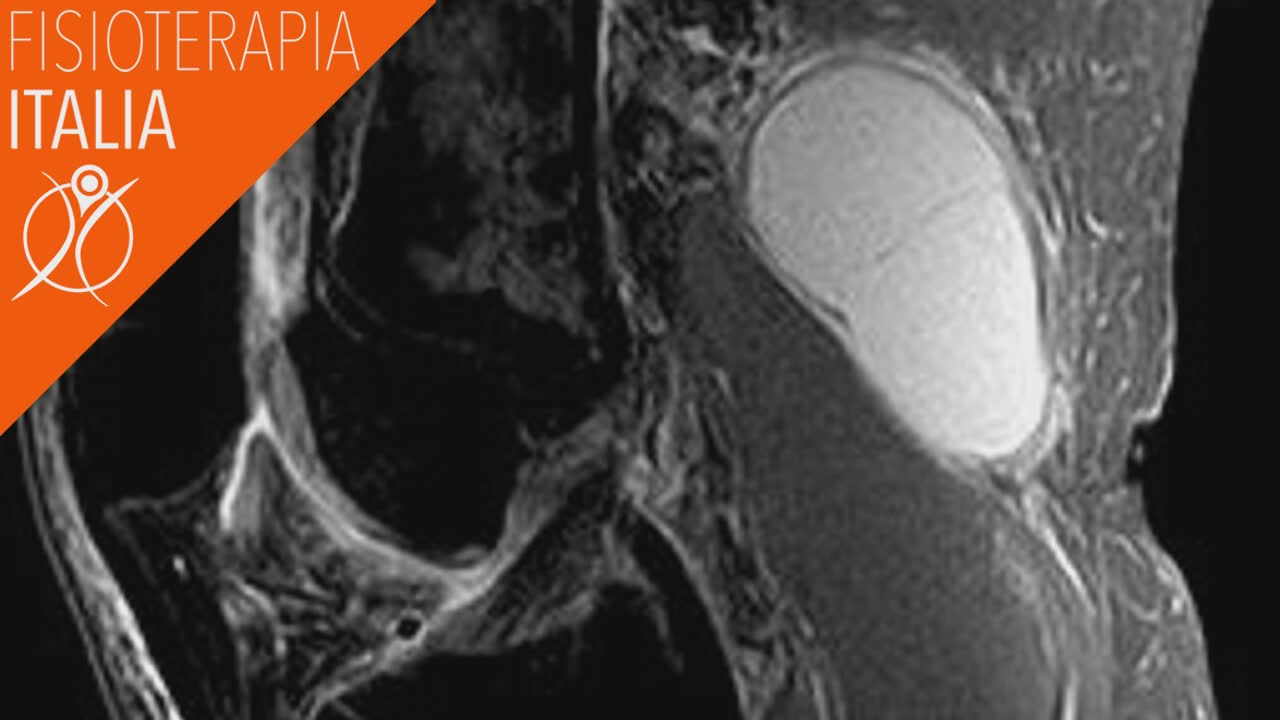 cisti di baker diagnosi