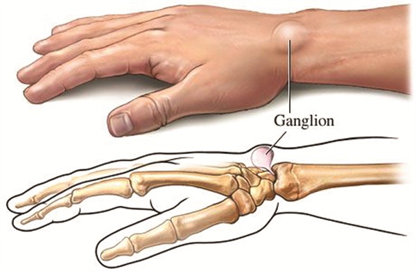 cisti tendinea