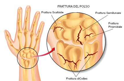 Colles frattura del polso