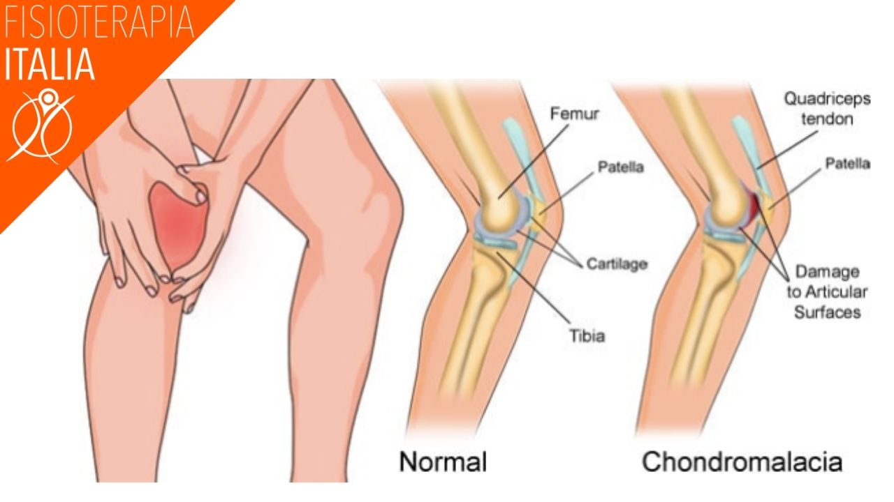 condropatia e sindrome femoro rotulea