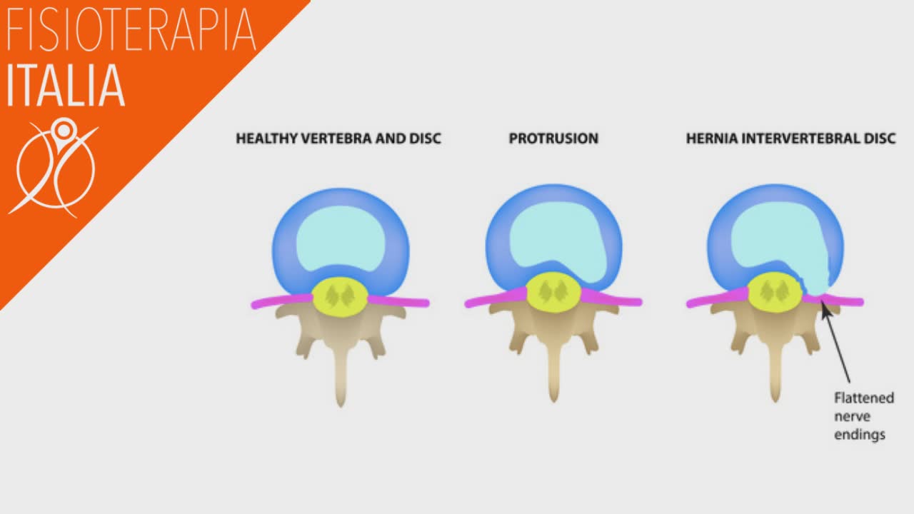 cosa è l'ernia del disco