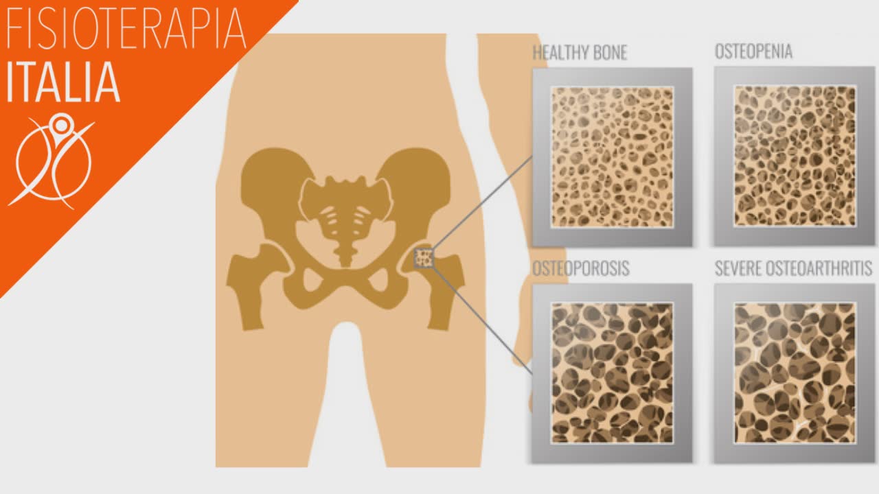 coxoartrosi diagnosi e cura